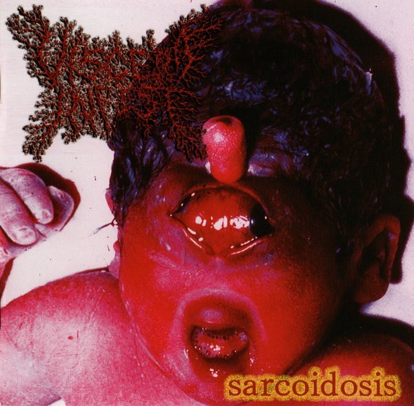 最新品国産VISCERA INFEST / Sarcoidosis アナログレコード 邦楽