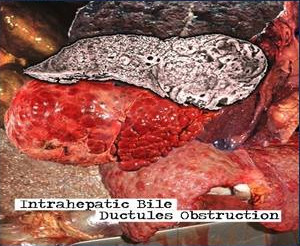 lataa albumi Biliary Cirrhosis - Intrahepatic Bile Ductules Obstruction