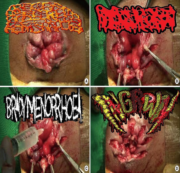 View credits, reviews, tracks and shop for the 2016 CDr release of Rectal Fissure Hemorrhoids / Hydrocephalus / Bradymenorrhoea / Ingrown on Discogs.