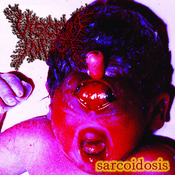 Viscera Infest – Sarcoidosis (2007, CD) - Discogs